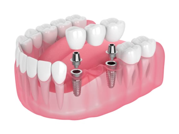 Illustration of an implant bridge